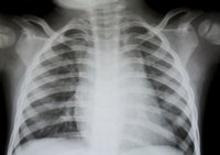 Kronisk obstruktiv lungesygdom har store konsekvenser for mange danskere.
