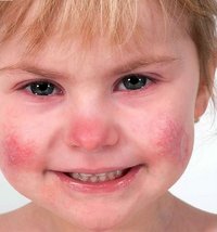 The girl suffers from the disorder SAVI, whereby the cells in her body constantly release molecules that cause inflammation. This results in severe skin eczema, problems with lung function and impaired growth. Photo: National Institutes of Health.