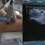 Med ultralydsteknik skal 9 ud af 10 patienter kun stikkes én gang for at få anlagt et arteriekateter