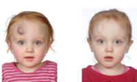 På billederne ses forskellen på før og efter behandling med propranolol hos en patient behandlet på Aarhus Universitetshospital.